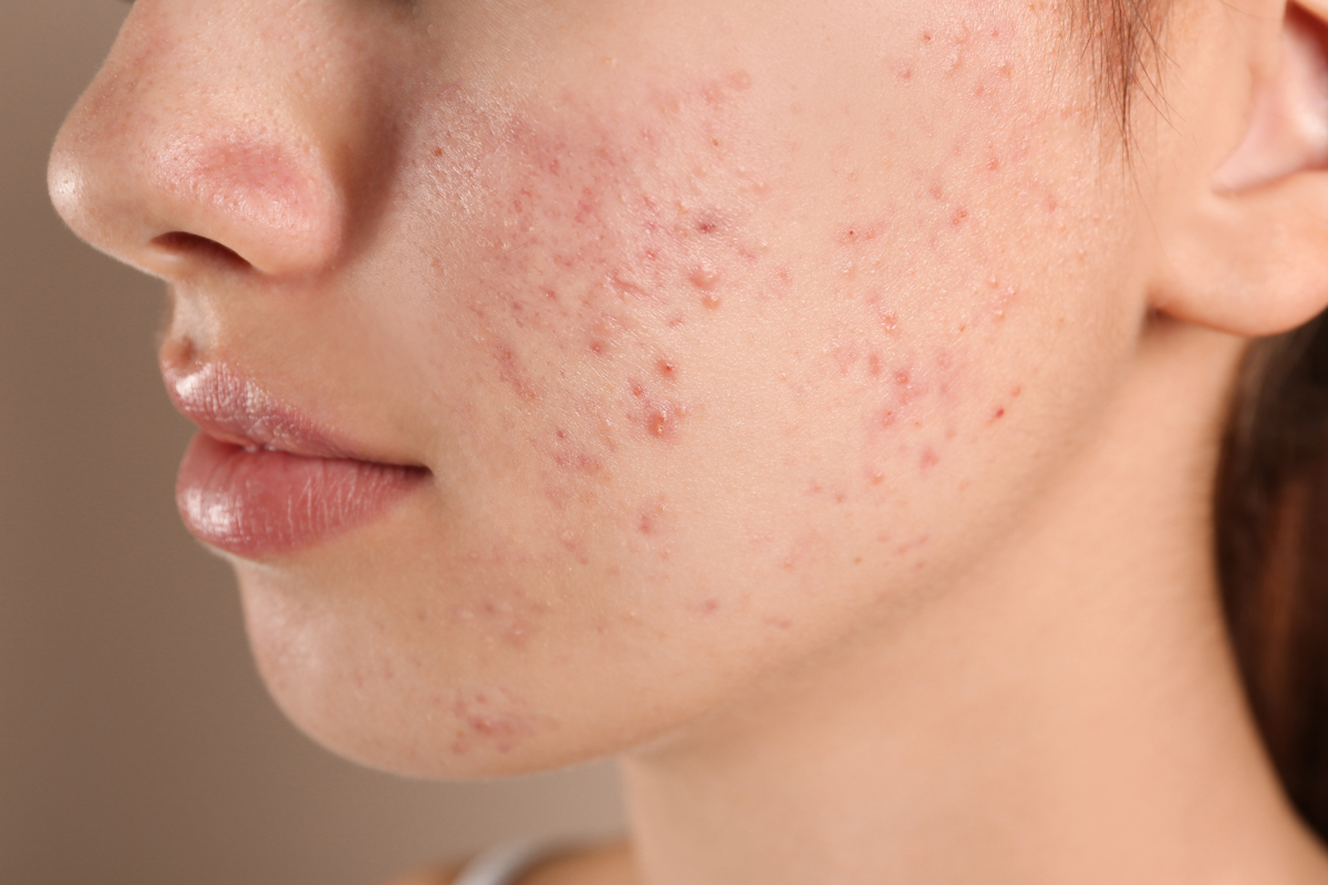 Acne & Breakouts on young woman's face