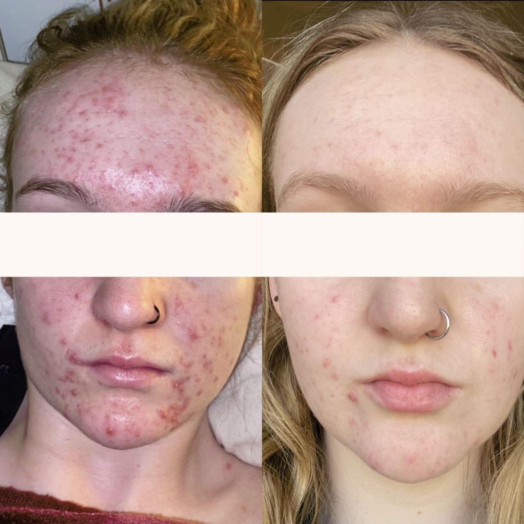 Before and after results from regular in clinic skin treatments