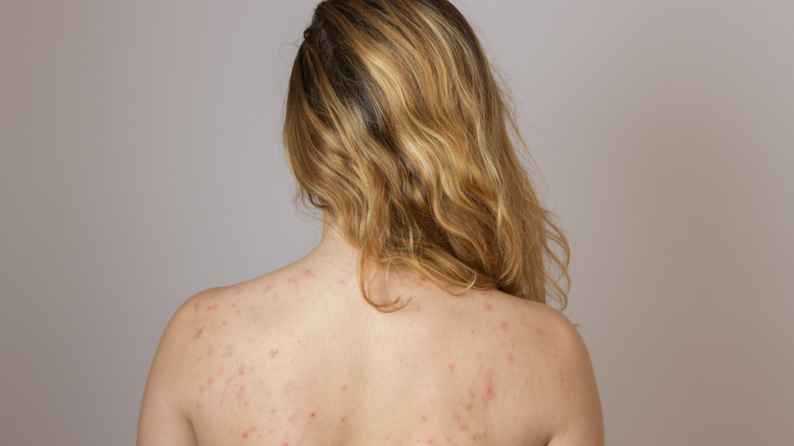 Young girl with acne, with red and white spots on the back