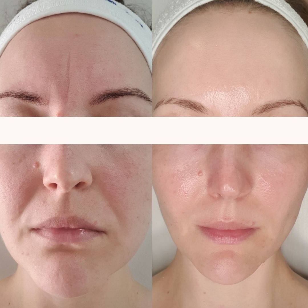 Before and after results from regular in clinic skin treatments