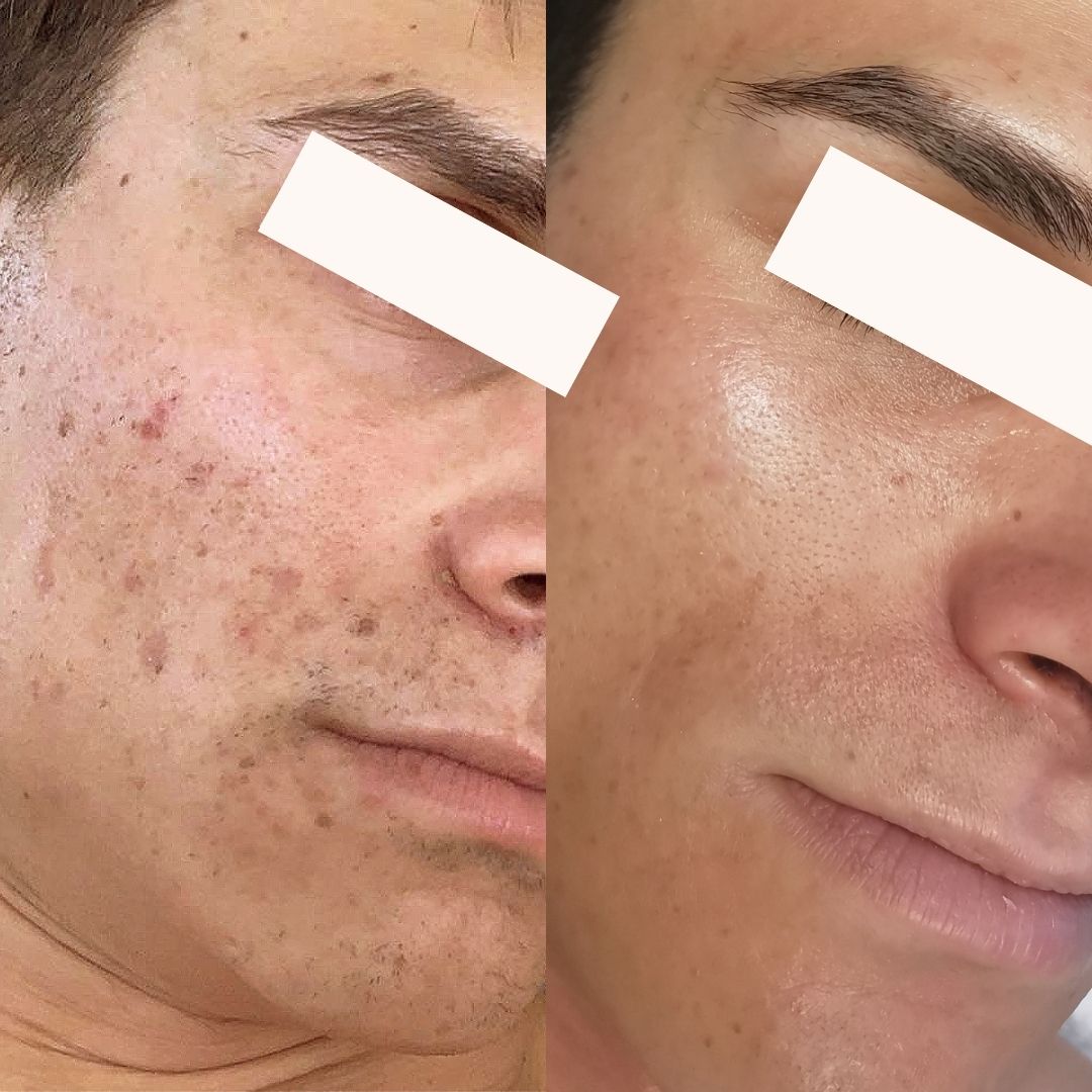 Before and after results from dermapen GOLD microneedling skin treatments