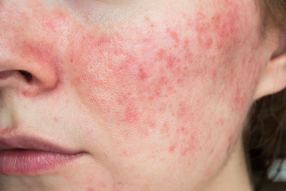 Woman with redness & rosacea on face