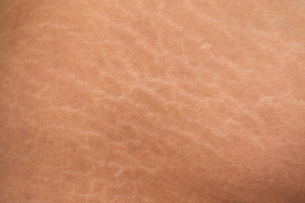 Close up of scarring & stretch marks