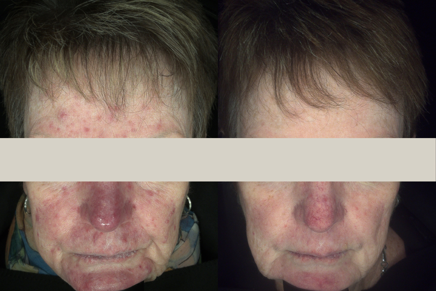 Treating Rosacea before and after result