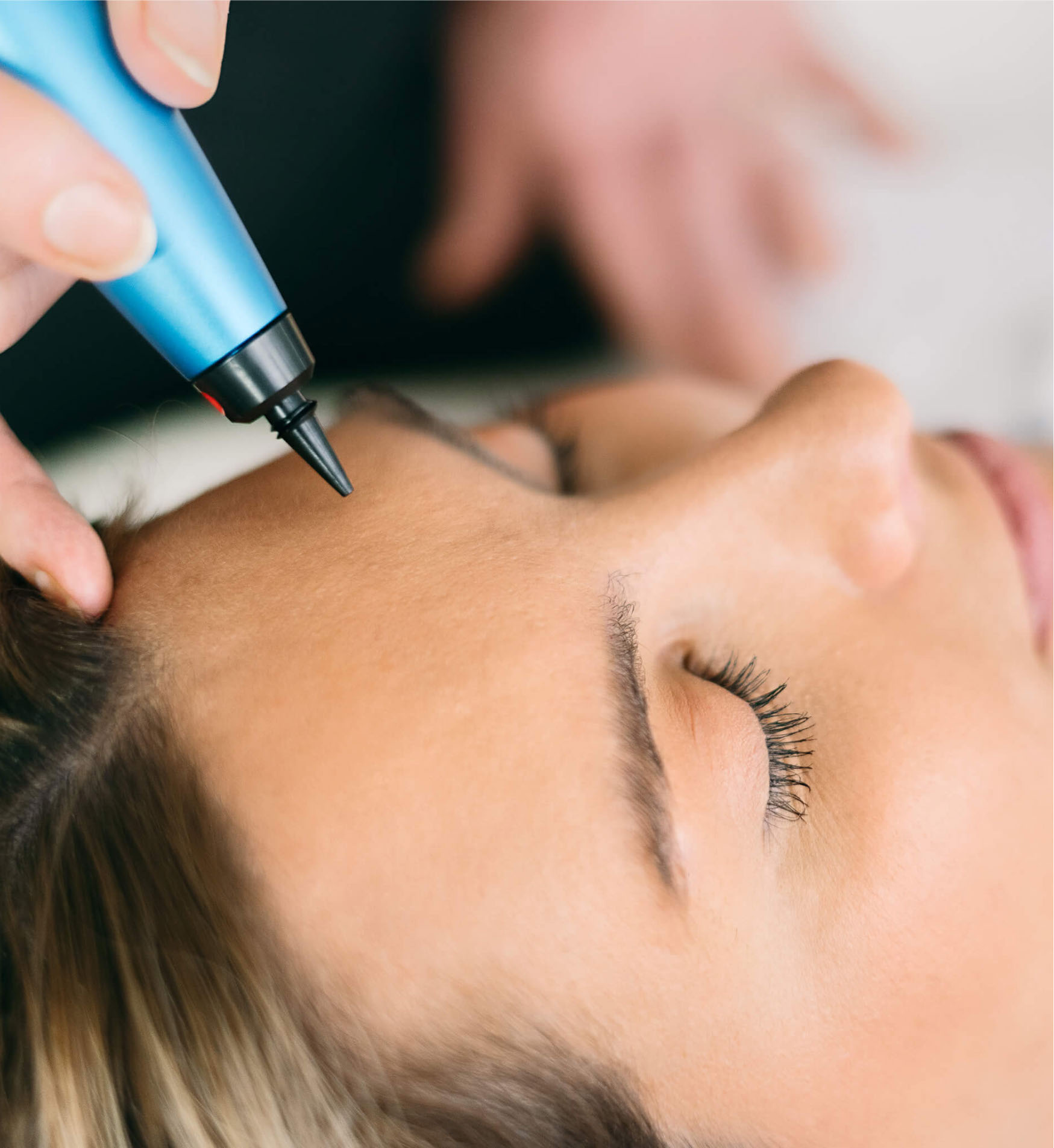 cyropen being used on woman's forehead