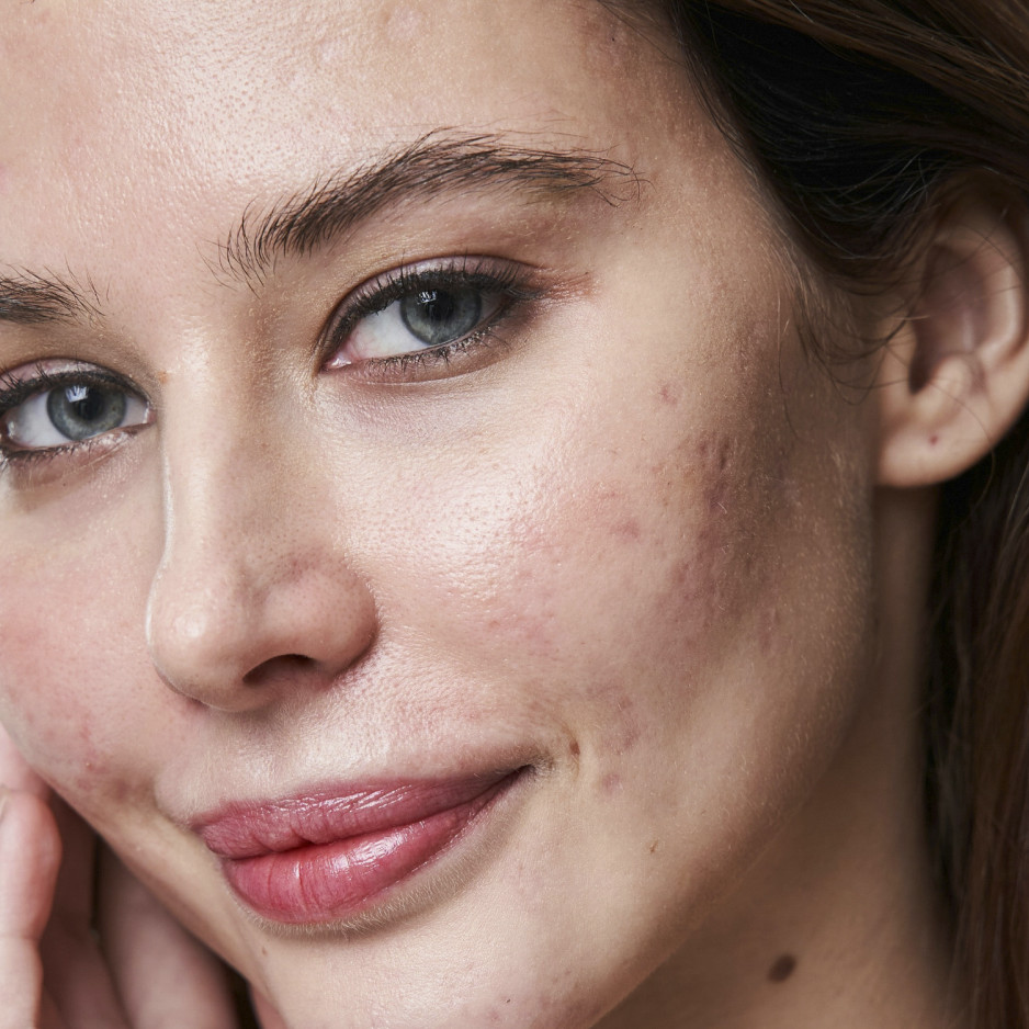 woman with acne scarring on face